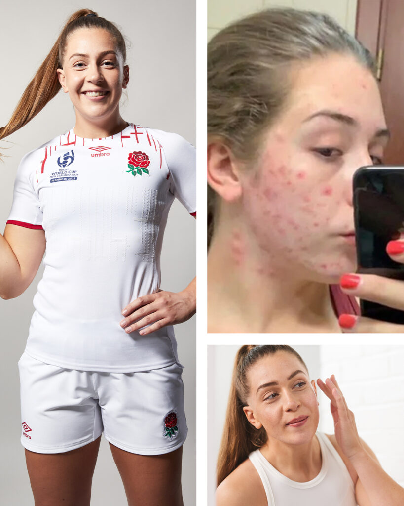 Collage of images of Holly Aitchison in her Rugby kit and her skin journey